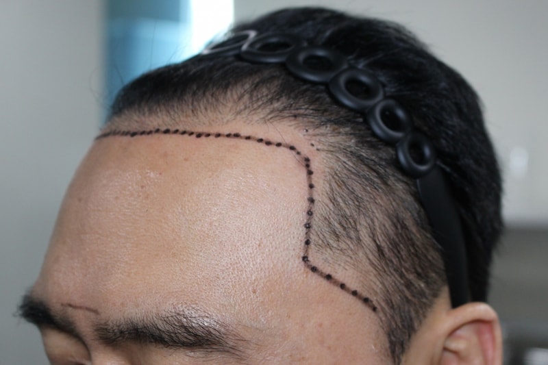 Modaol Yang Yoo-gun, Director, reviews 3,700 mother +@ incision transplant surgery