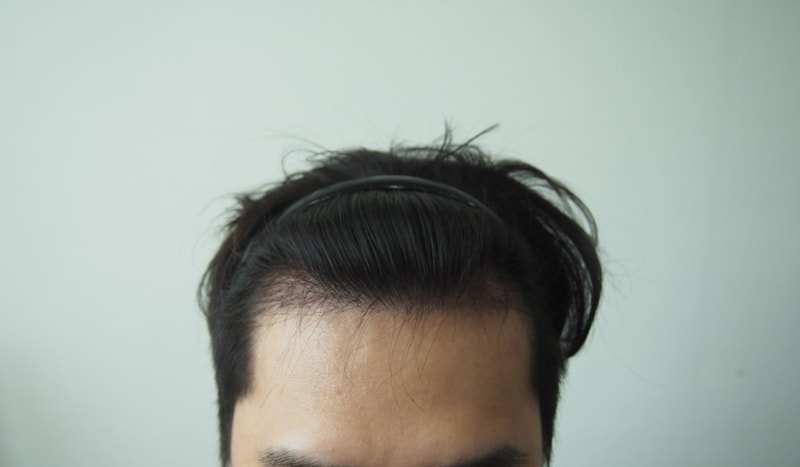 [ㅈㅅ] Four months have passed since the hair transplant