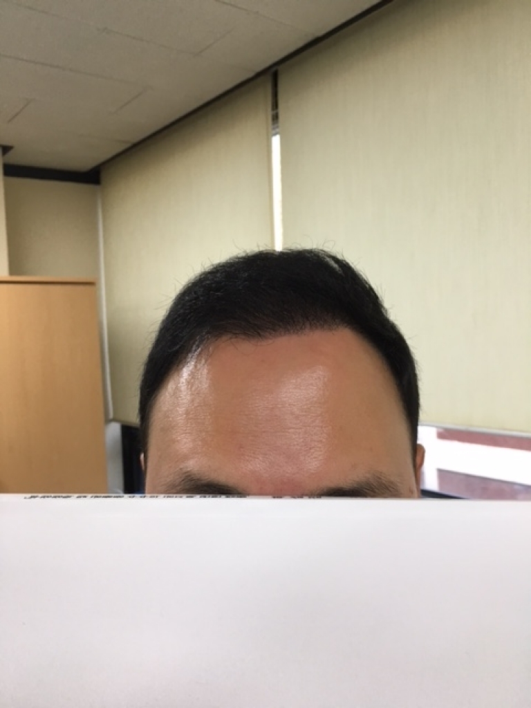 수술후 5개월-보통.JPG