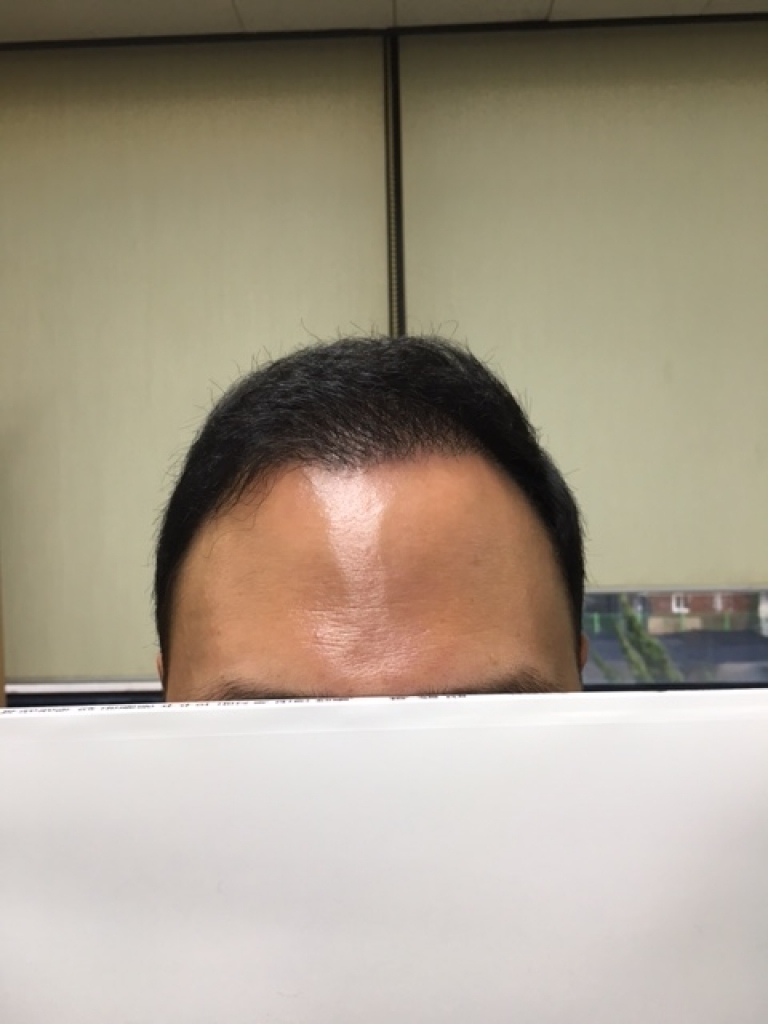 수술후 5개월-불빛.JPG