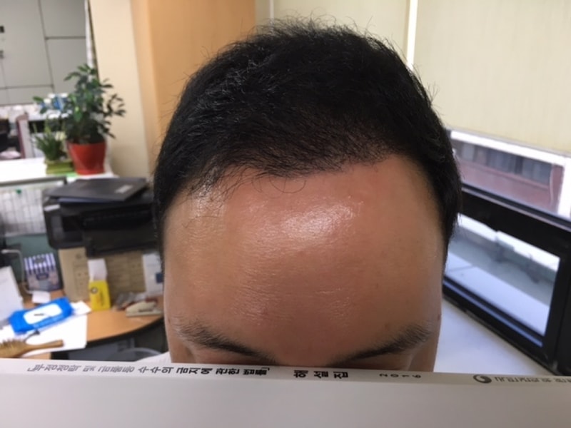 수술후 5개월-가까이.JPG