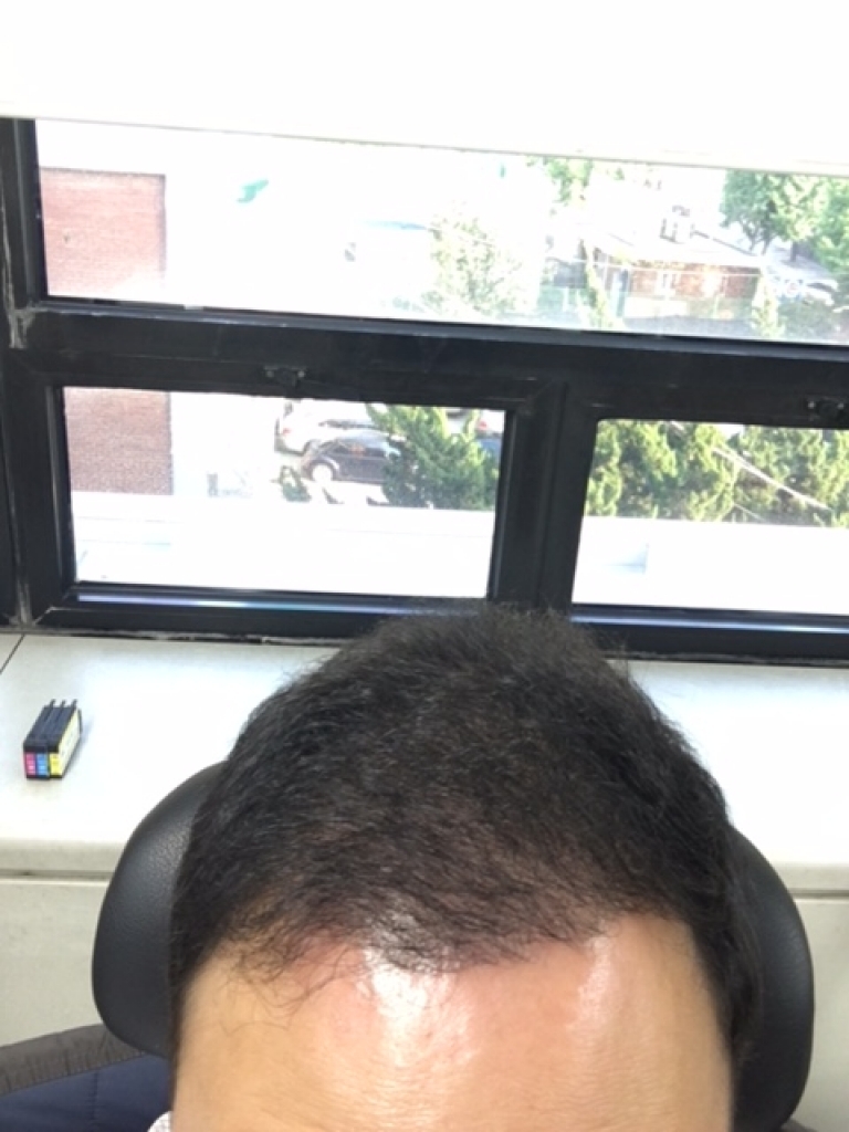 수술후 5개월.JPG