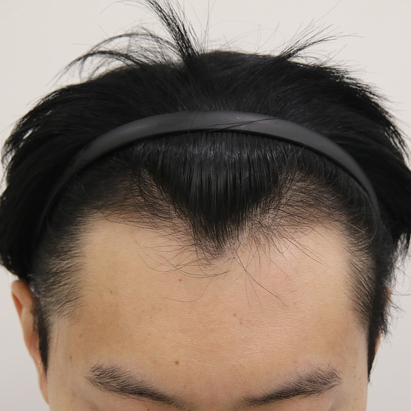 부산 모발이식 엠자 맘모스 2주 경과 되었습니다.