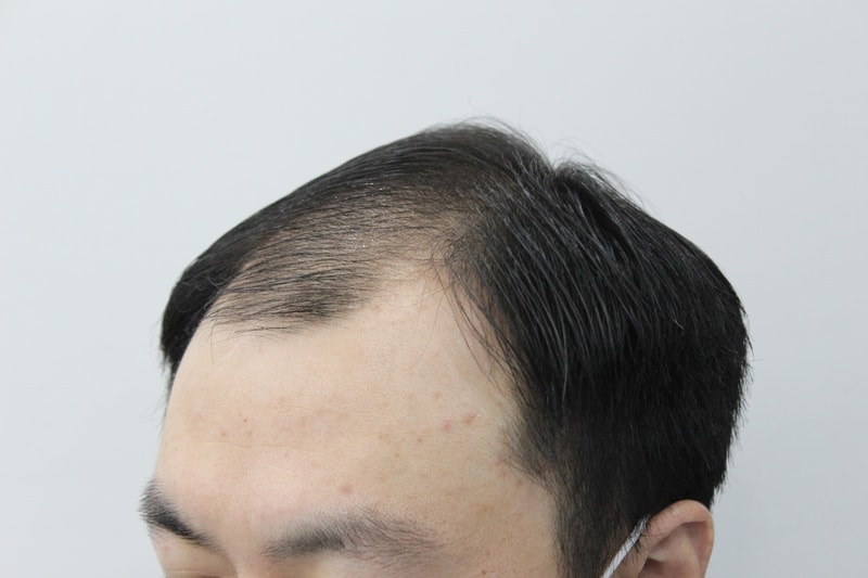 수술 전2.jpg
