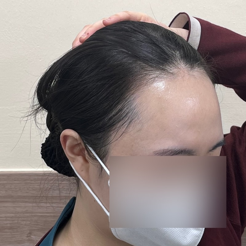디에이 성형외과 헤어라인 모발이식 4000모
