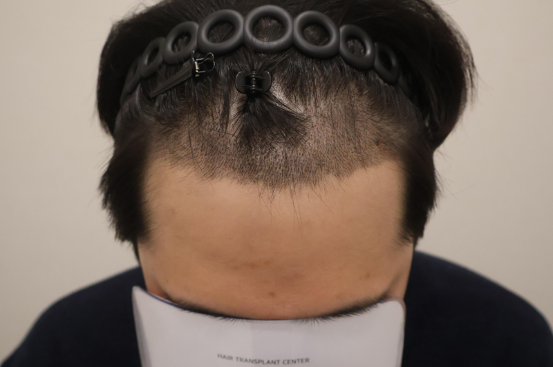 수술 후 3.png