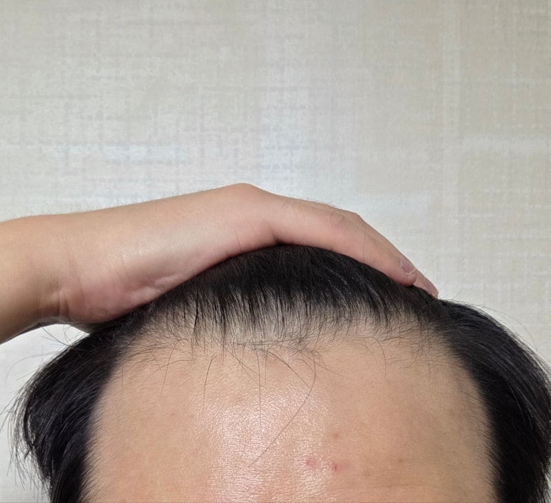 수술 당일 날 아침.jpg