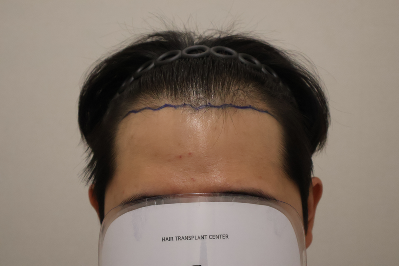 동탄헤어로의원 절개 모발이식 3200모 2주 경과 후기