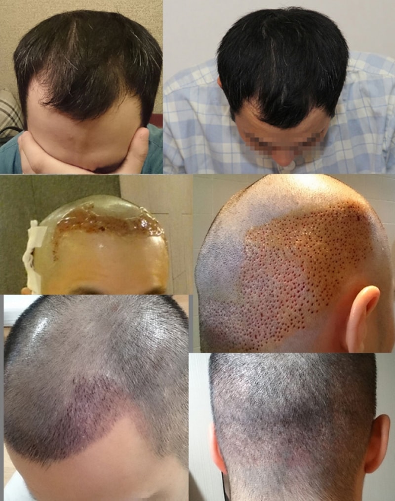 뉴헤어에서 1600모낭 이식한지 10일된 후기입니다
