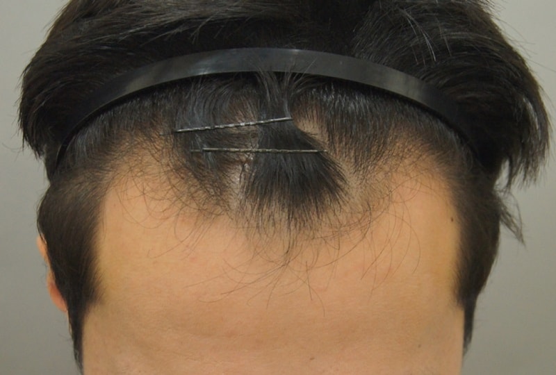 수술전.JPG