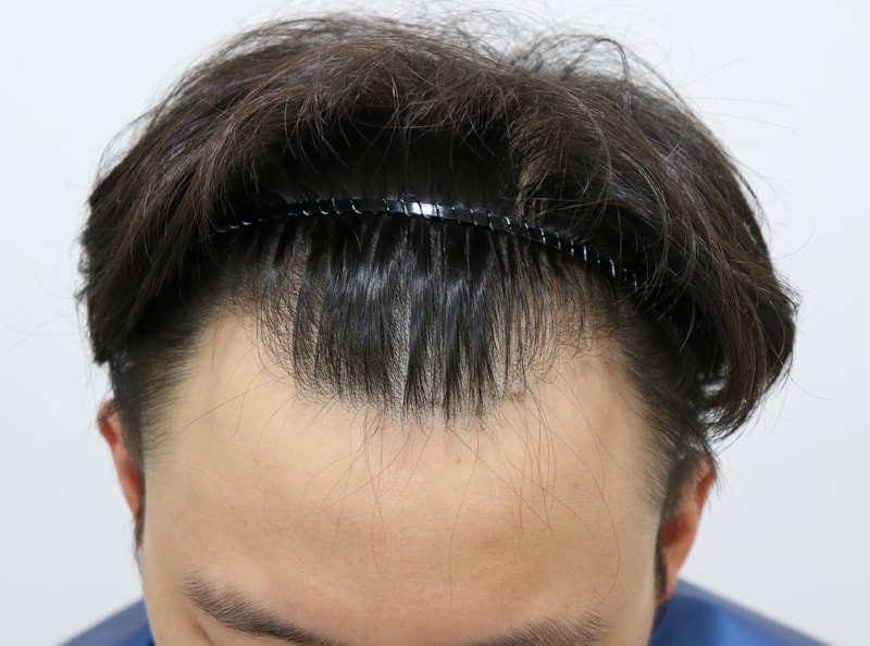 4026모 절개 모발이식 9개월이 되기까지의 변화