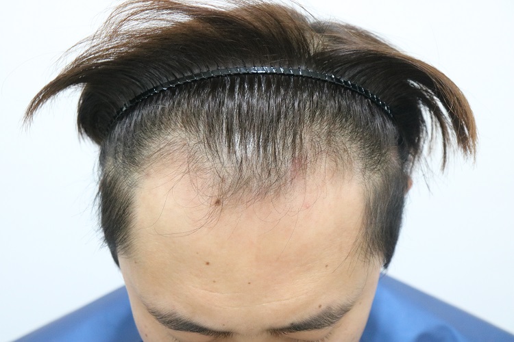 초진-45도.jpg