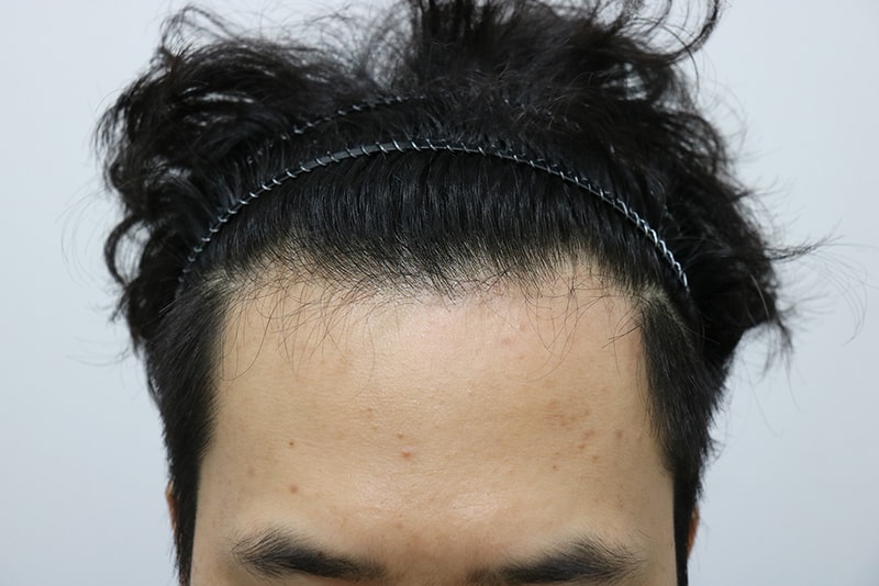 모스트 무삭발 비절개 수술 후기