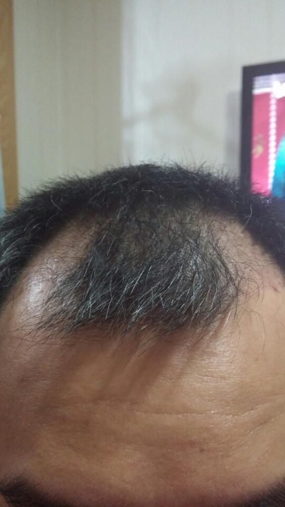 수술받고 7주 나긴나는거..?