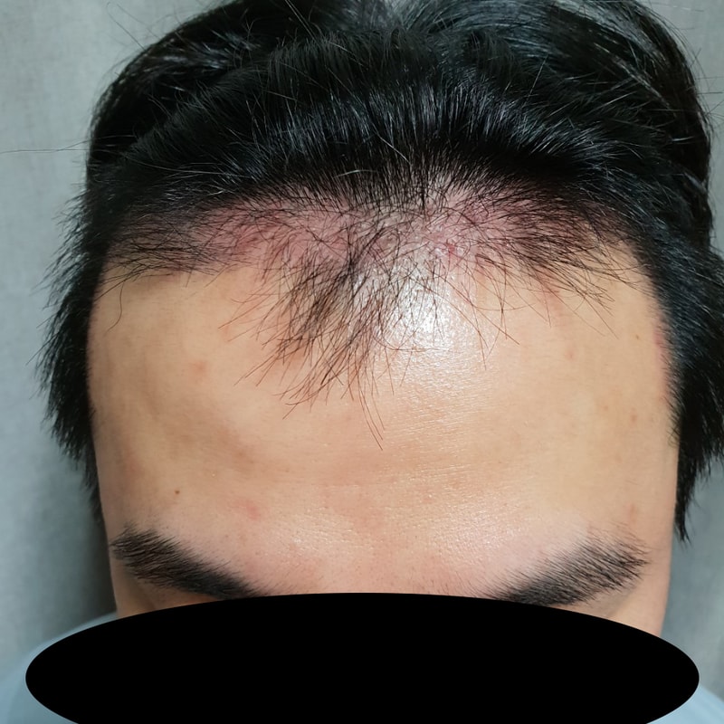 수술 2개월 차 후기 남겨보겠습니다.
