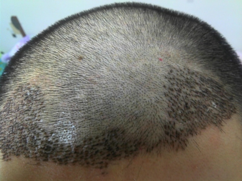 Motion 1000 hair follicles for 3 months. I'll post a picture for three months.