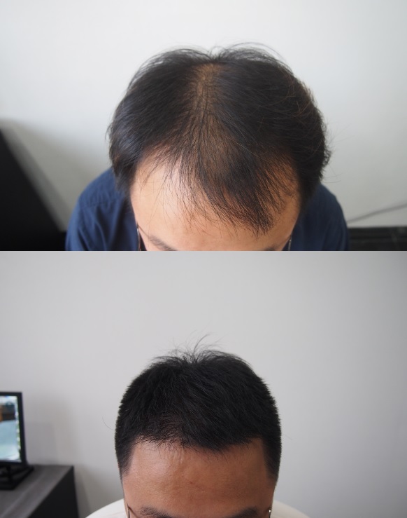 2788모낭 8개월 됐습니다.