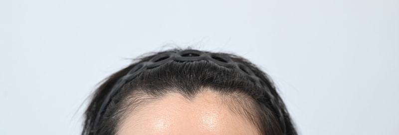 MOEM Clinic Female Hair Transplantation Late (before surgery, 3 months later)