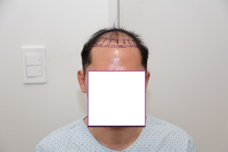 뉴헤어 절개 모발이식  5000모 9일차 후기(김진오원장님)입니다.