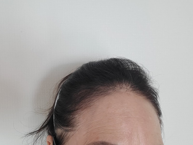 헤어라인 1200모낭