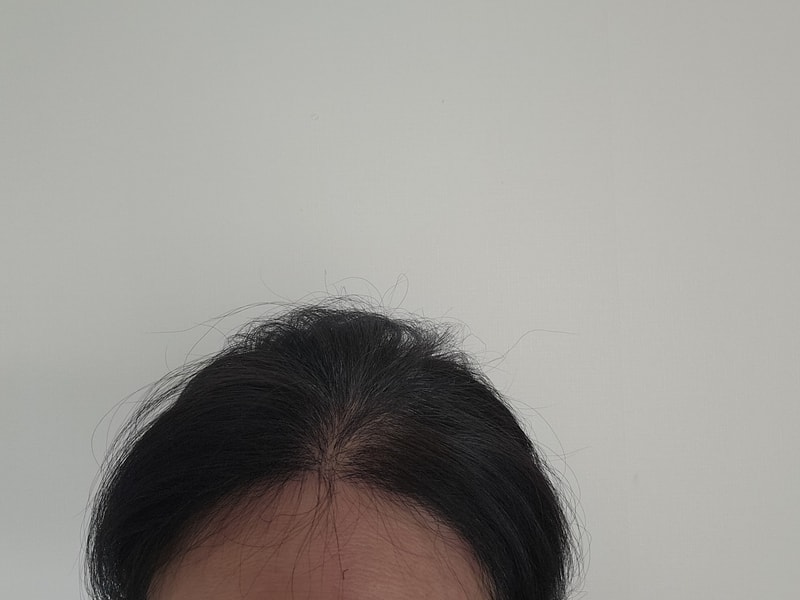 헤어라인 1200모낭 시술 8개월차