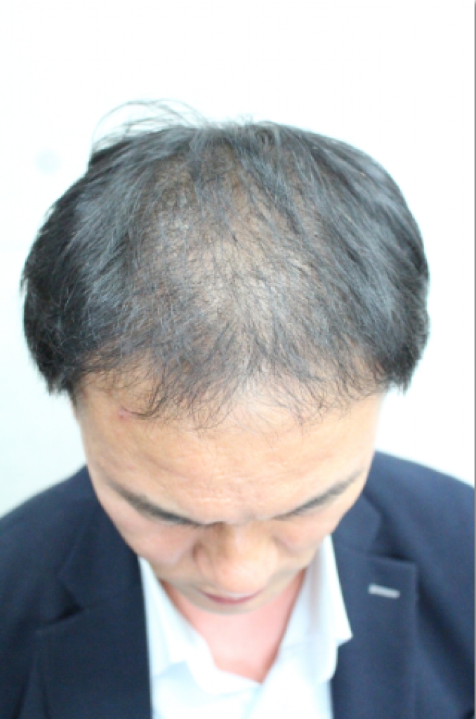 수술후 4개월모습.PNG