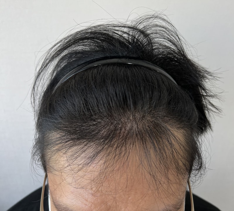 모재성성형외과 1200모낭 비절개 모발이식 8개월 경과 후기