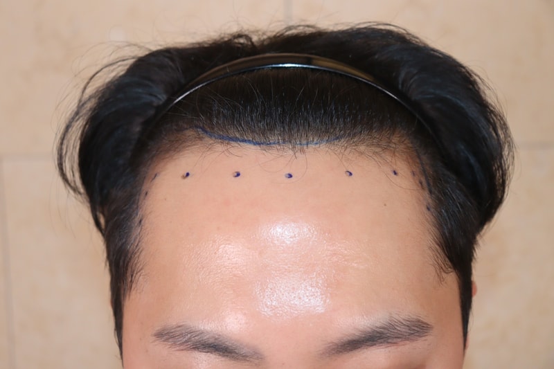 This is a review of 4,000 moles of Umchan Clinic incision (1st day)