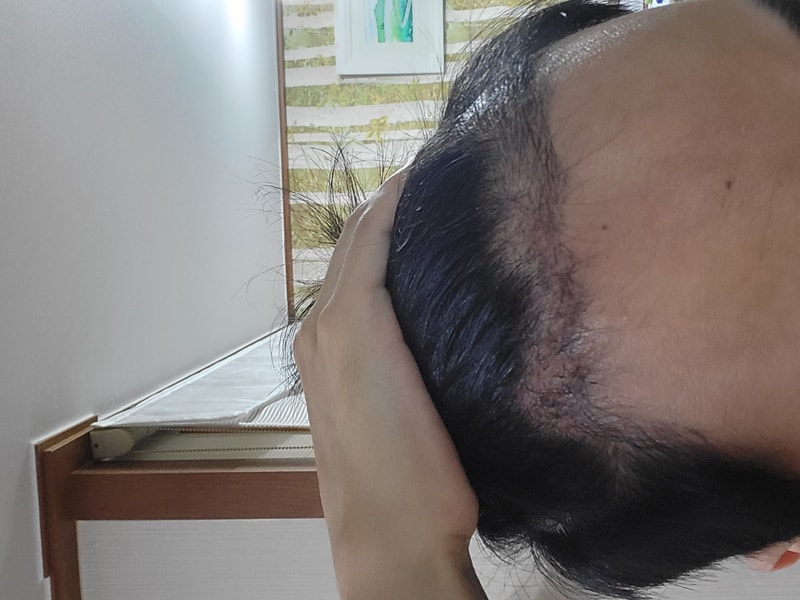 압구정 모우림 절개 M자 4개월 차 후기입니다.