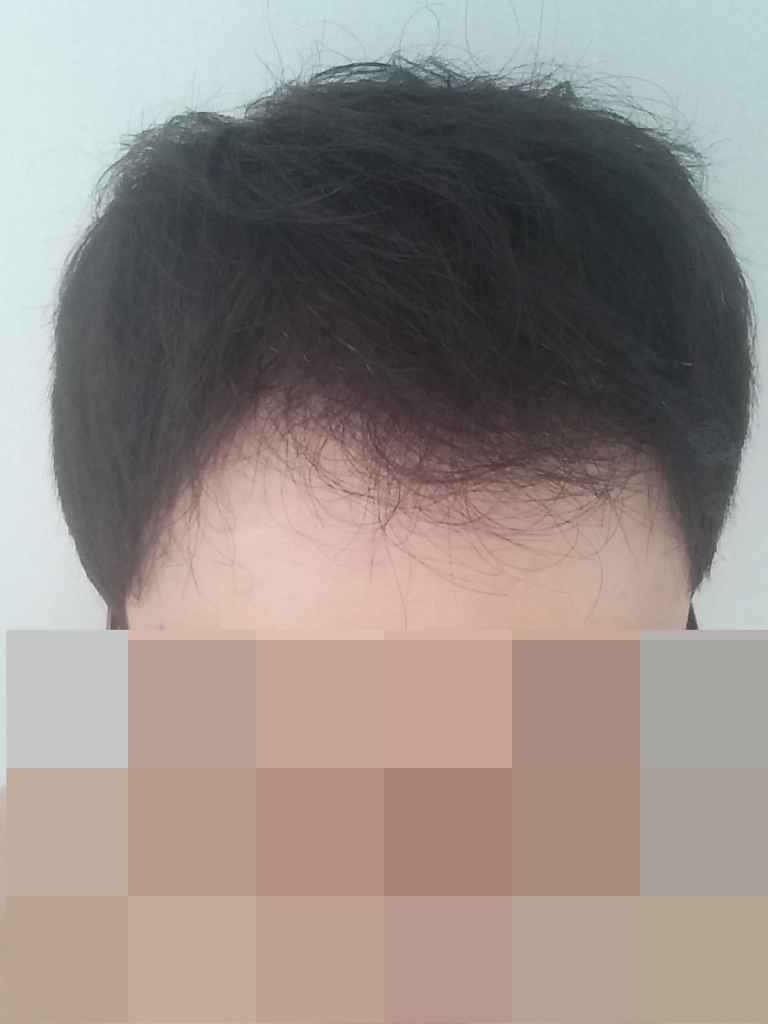 비절개 2500모낭 평가 두번째 고고고