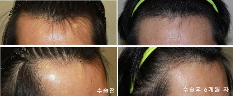 수술전후2.jpg