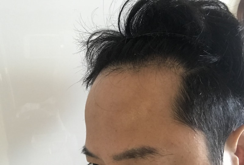 이식전 좌측.jpg