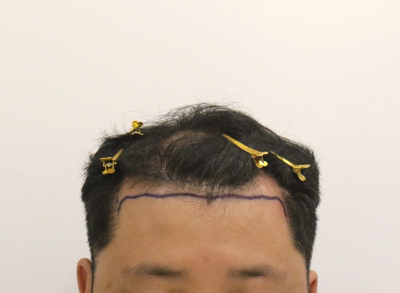 釜山植毛スリット方式マンモスM字+整数里4ヶ月後記