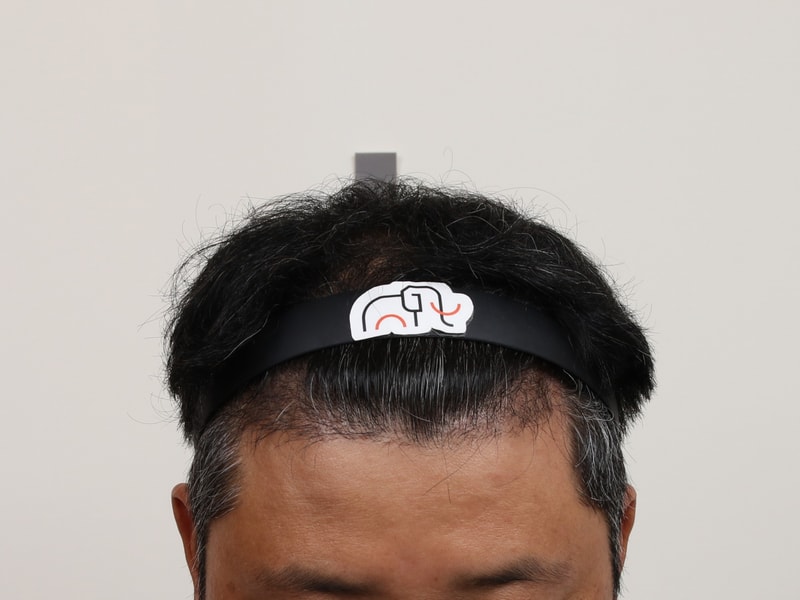 수술 경과 4개월.jpg