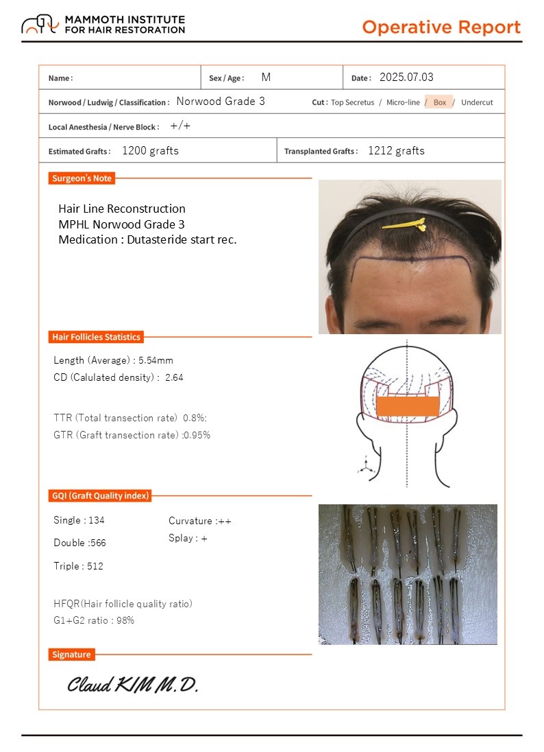 Busan Hair Transplantation Slit Method Mammoth M-Shape + Postoperative Day Review