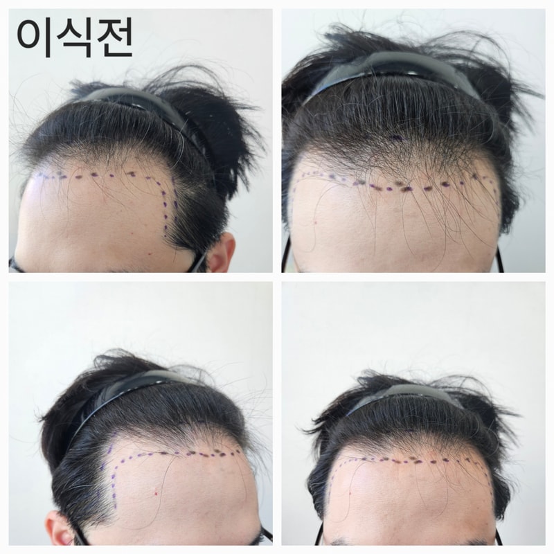 [압구정 모재성 성형외과] 수술 직후, 8일, 6주차 후기