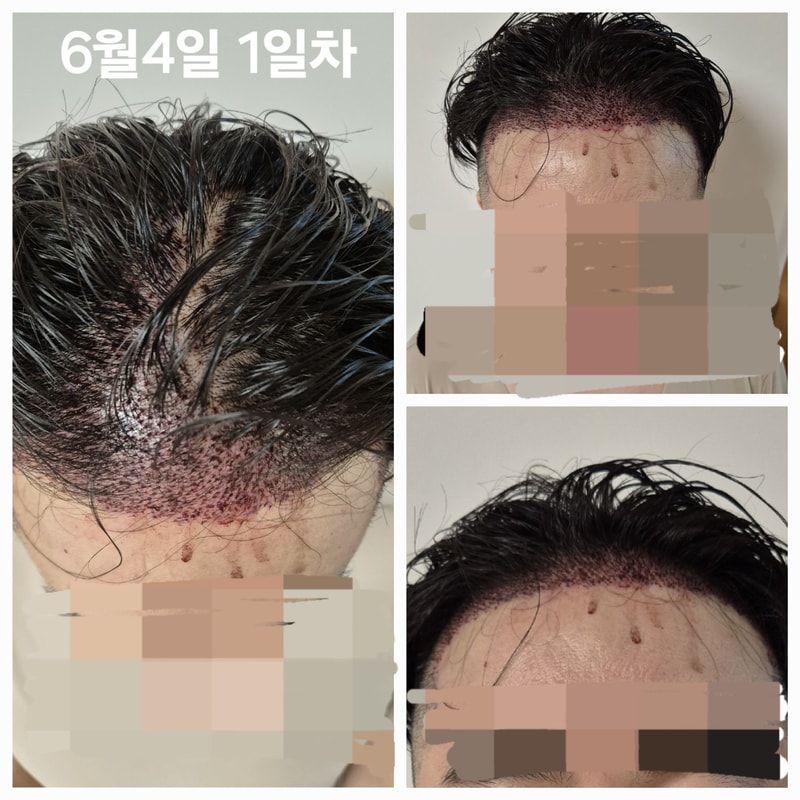 이식직후.jpg