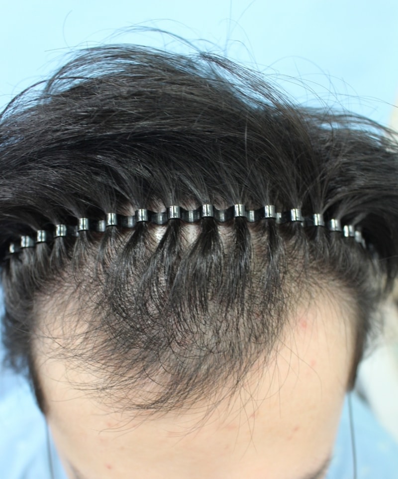 I have a 3000 hair incision transplant.