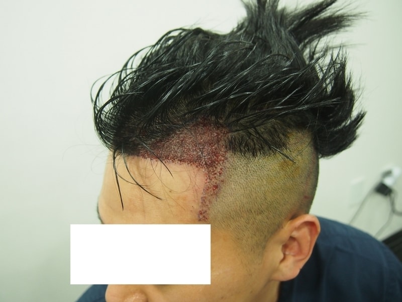수술 후 측면 좌.jpg