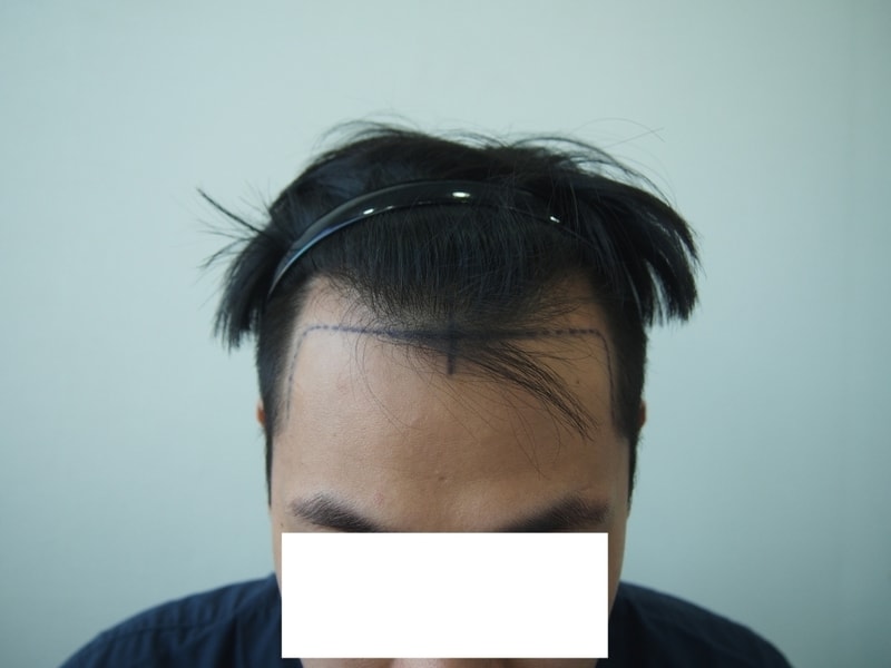 수술 전 디자인 정면.jpg