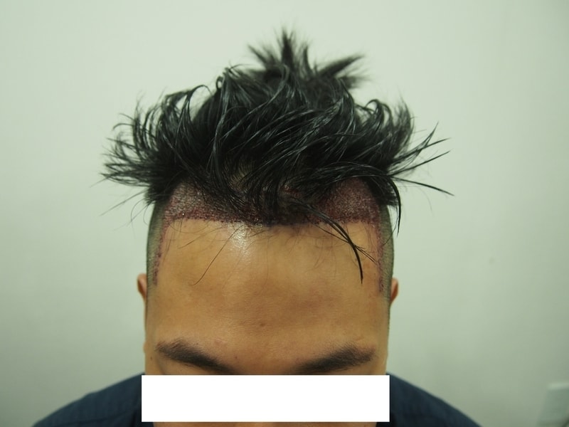 수술 후 정면.jpg