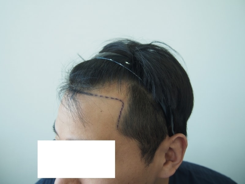 수술 전 디자인 측면 우.jpg