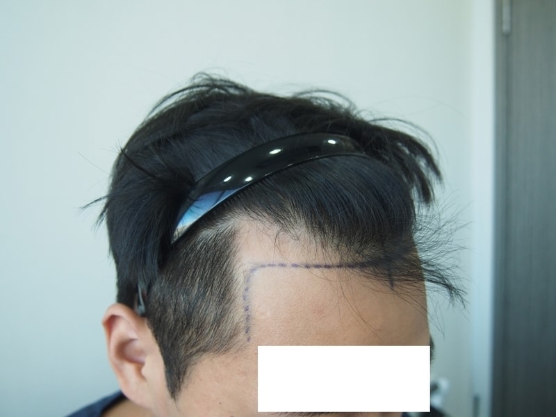 수술  전 디자인 측면 우.jpg