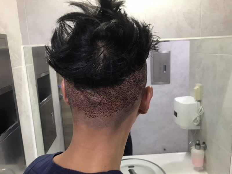 후두부 채취부분.jpg