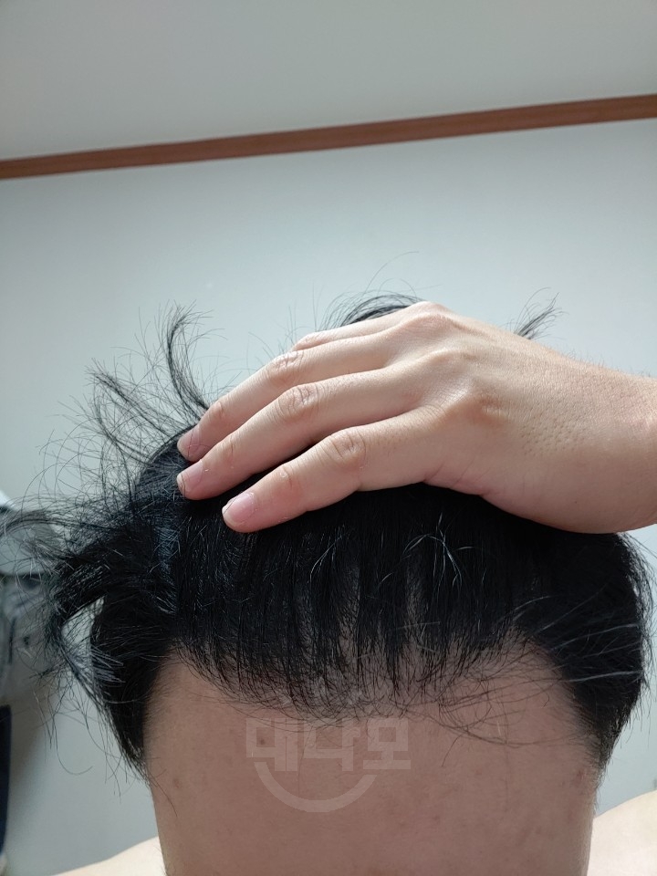 모재성 비절개 1년차 후기입니다.