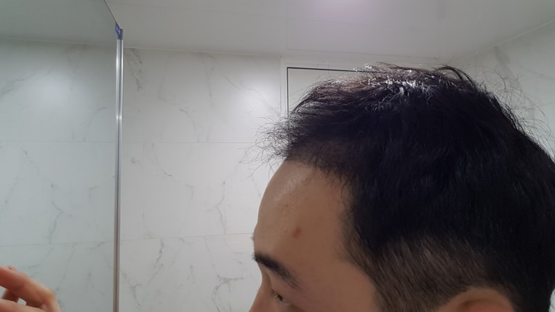 모재성 비절개 4달차 후기입니다!