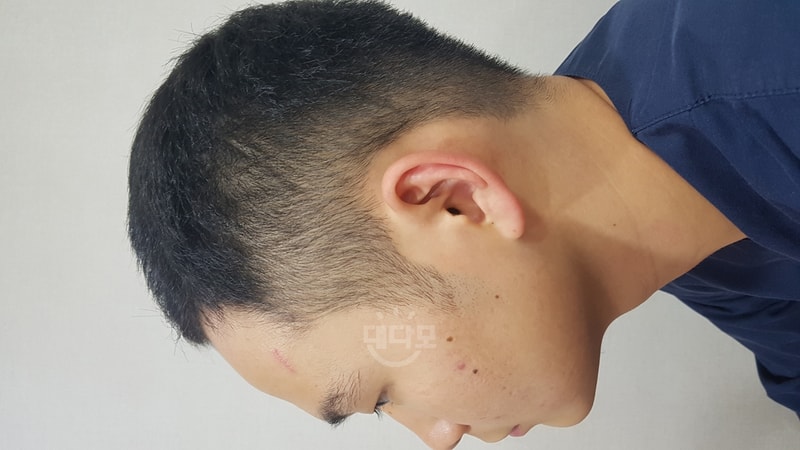 모재성 비절개 8개월 차 후기입니다