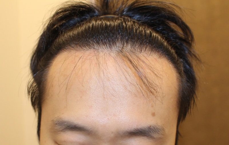 수술후 1.JPG