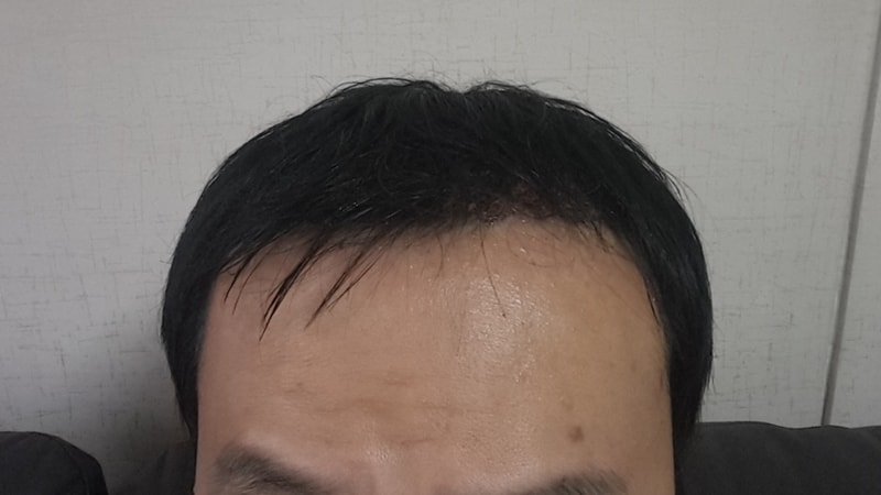 수술직후 3.jpg