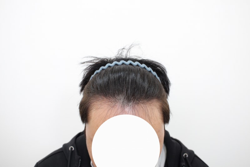 신사동,모프로의원,♣의사지인추천모발이식,15일차
